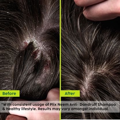 Neem Anti-Dandruff Advanced Shampoo for Reduced Dandruff & Itchiness