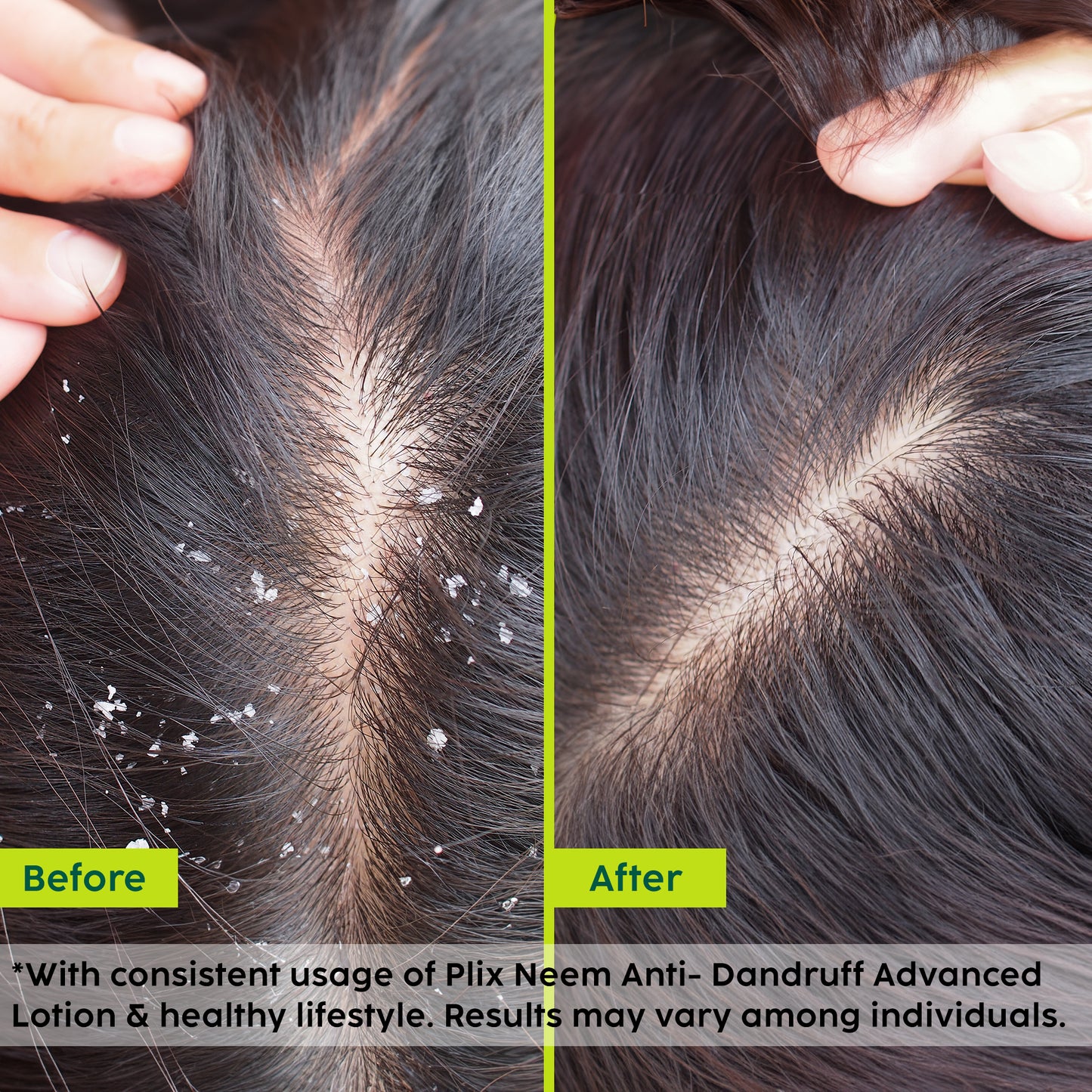Neem Anti-Dandruff Advanced Lotion