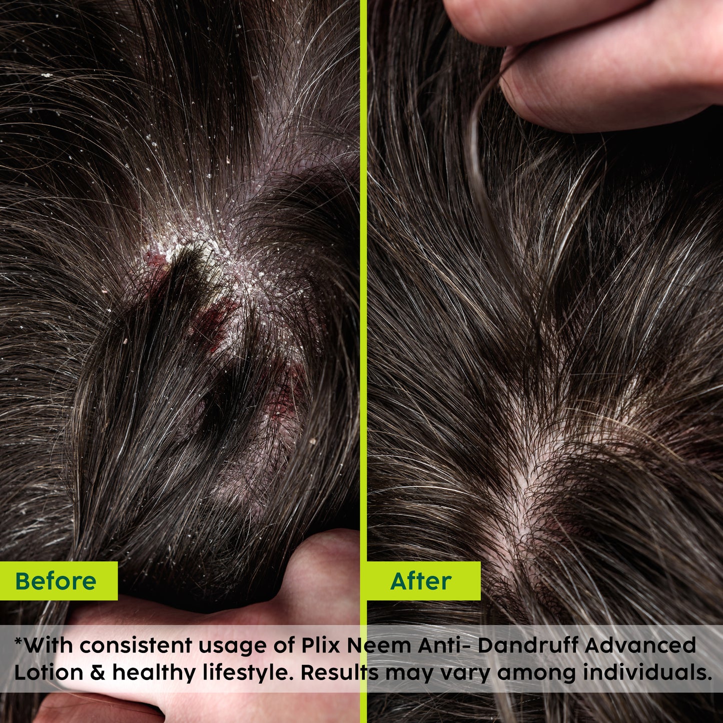 Neem Anti-Dandruff Advanced Lotion
