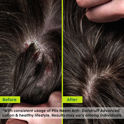 Neem Anti-Dandruff Advanced Lotion
